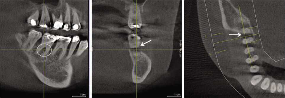 Three images depecting a periodontal furcation involvement of a second molar (Picture Courtesy: Donald A. Tydall, Sonathe Rathore – The Dental science of North America).