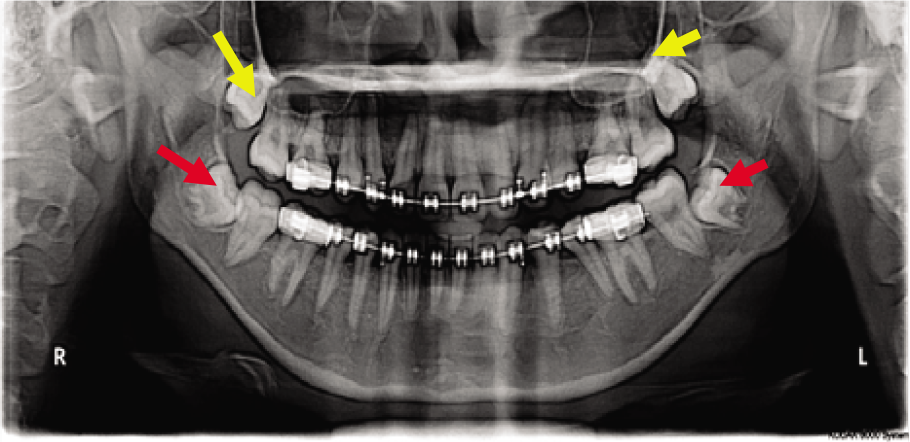 Partly Impacted Mandibular Third Molars.