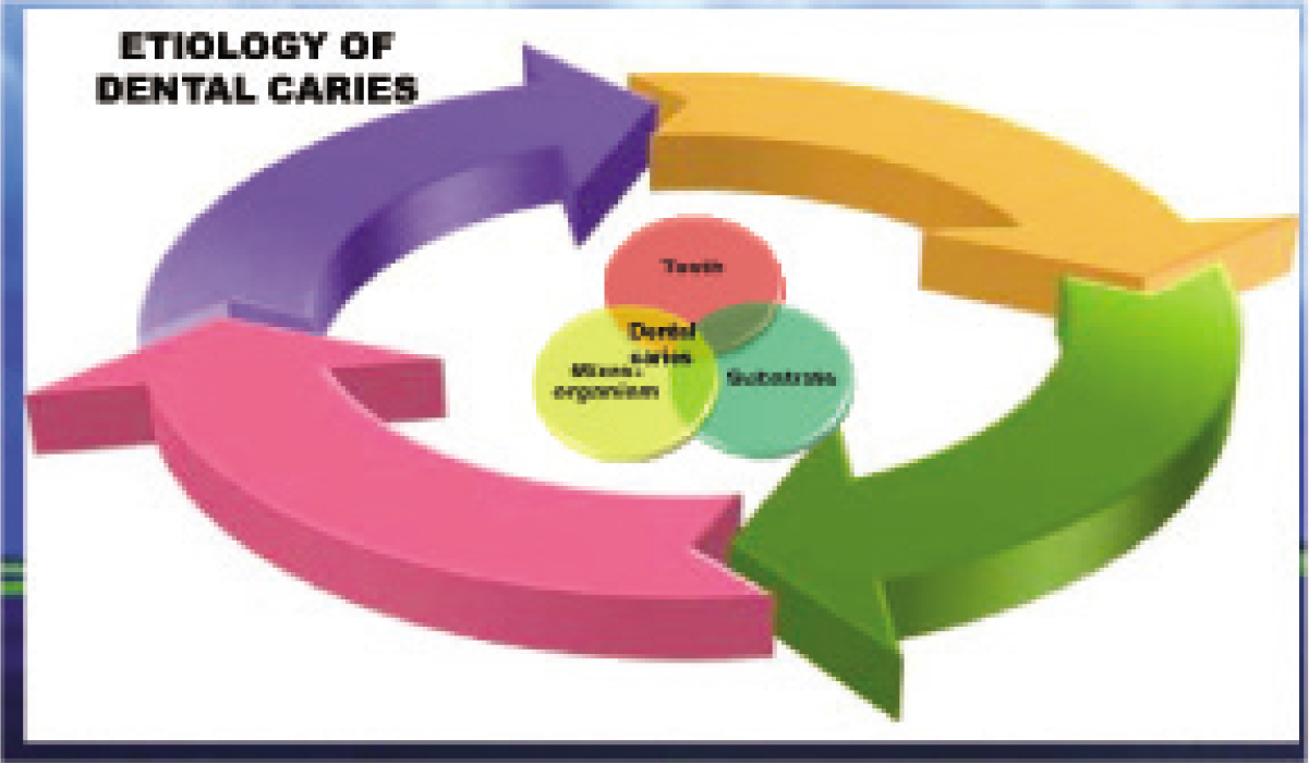 Etiology of dental caries.