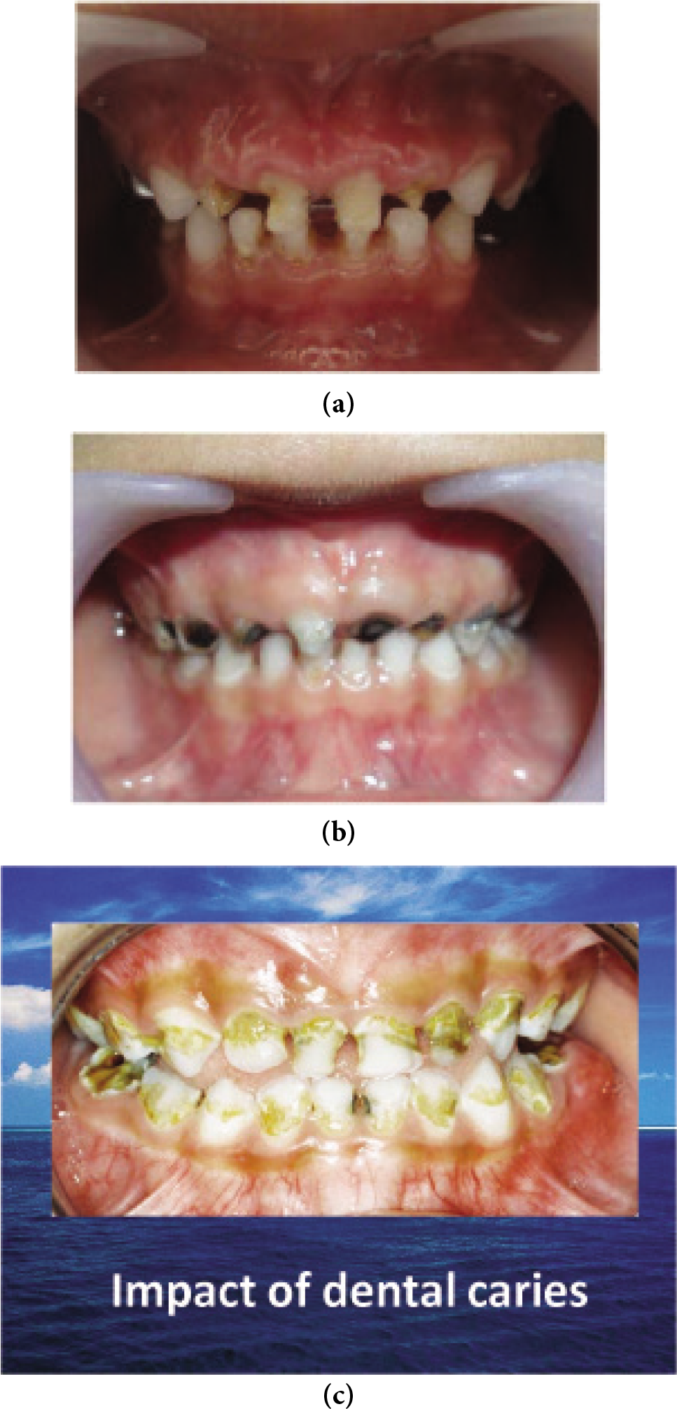 (a)-(c) Adherence of mutans Streptococci on the oral Biofilm.