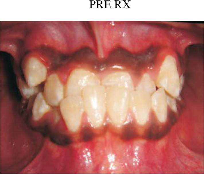 Teeth with inital occlusal discrepancies.