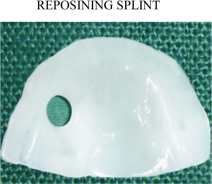 Oral splint Appliance.