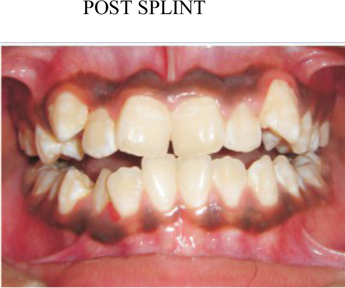 True malocclusion with condyles seated in fossa.