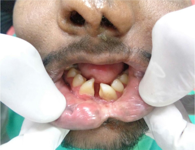 Preoperative intraoral picture.