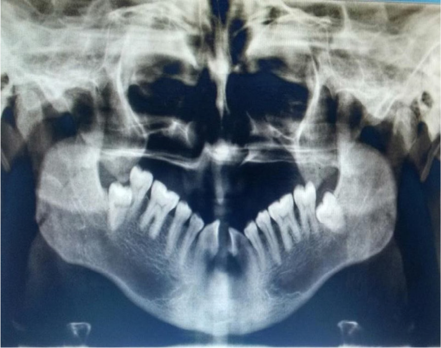 Orthopantamogram shows complete absence of the maxillary teeth, and the mandibular central incisors and lateral incisors. The cleft involving midline of the mandible and small notching is present on mandibular alveolous with mesial drift of the remaining teeth.