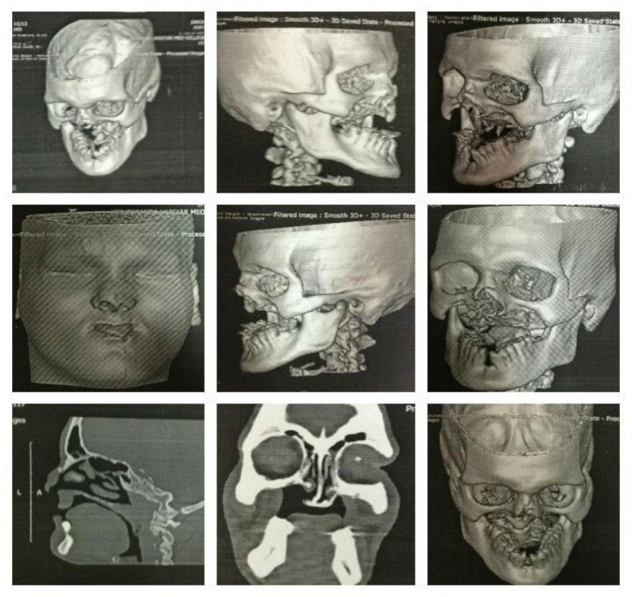 Computer tomography of facial bone shows non visualization of maxilla and its alveolar process and all upper teeth .Palatine process of maxilla is poorly visualized with defect in visualized posterior part of hard palate and communication between oral and nasalcavity.