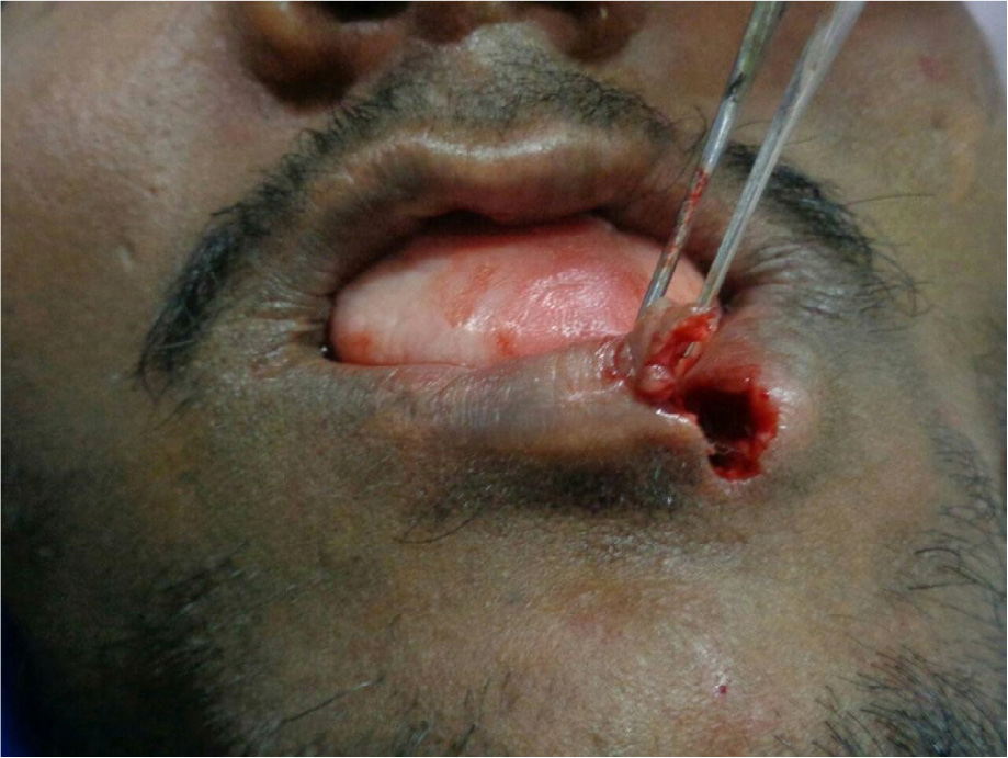 Under local anesthesia 1:80000 infiltrated in the lower lip by using No:11 blade vermilion border is desected, triangular shape vermilion flap is reflected.