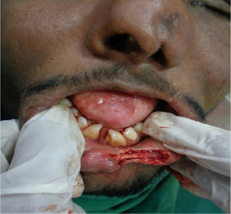 Orbicularis oris muscle is dissected by using iris scissors.