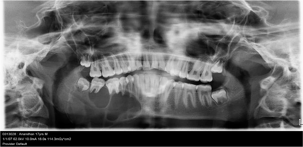 Panoramic radiograph- Large multi cystic radiolucencies extending to lower border of the mandible.