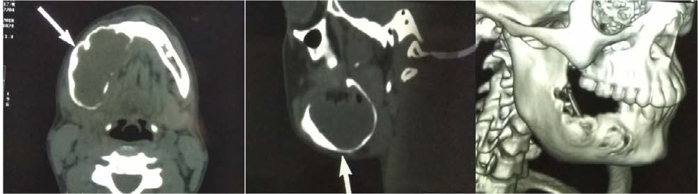 Computed Tomography (CT)- Large radiolucency extending to lower border of the mandible.