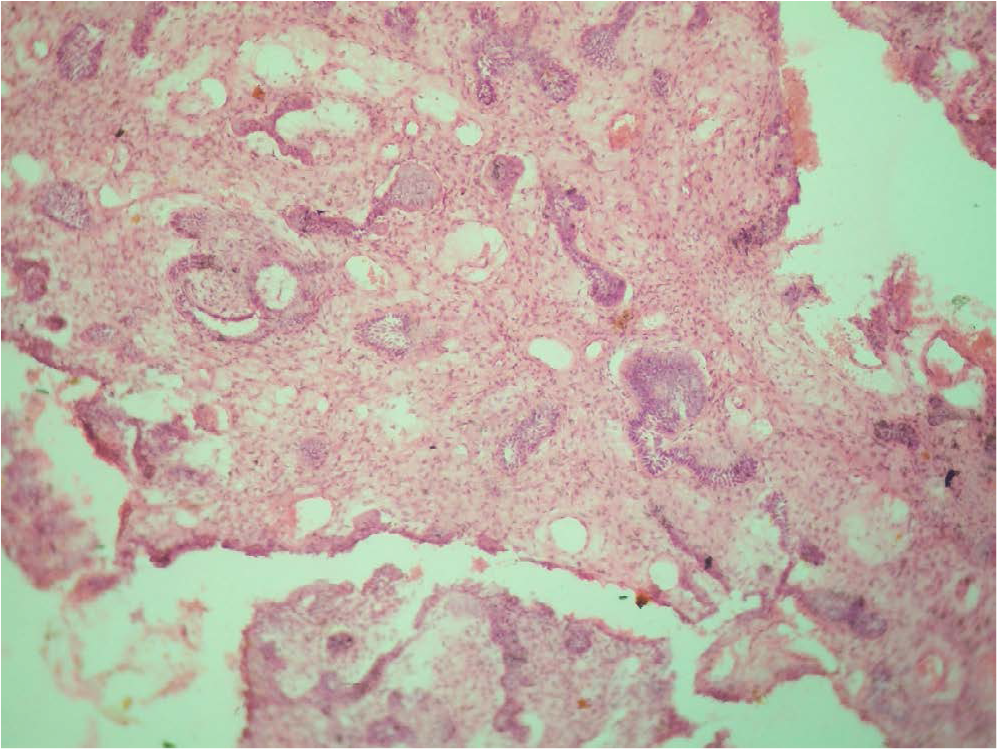 Photomicrograph revealing odontogenic epithelial cells presenting a follicular pattern (10x).