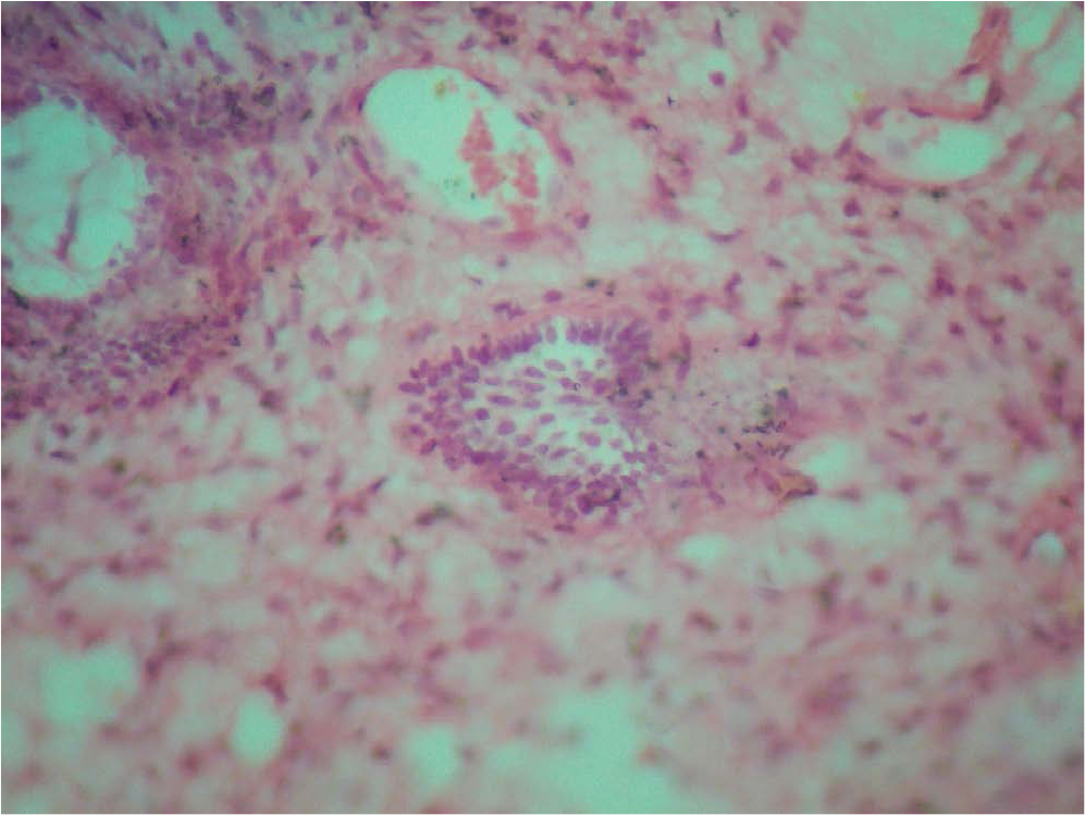 Photomicrograph (40x)- High power showing a single ameloblastic follicle.