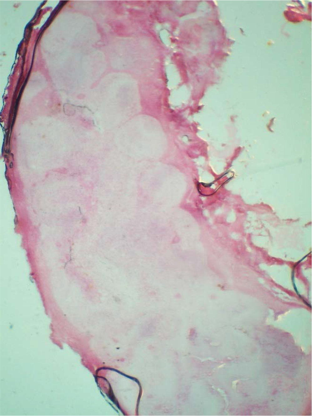 Photomicrograph (4x)- Low power view showing the cross section of the suspicious lymphnode.