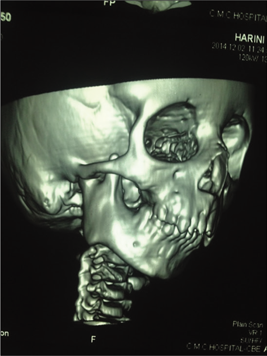 CT scan – right side.