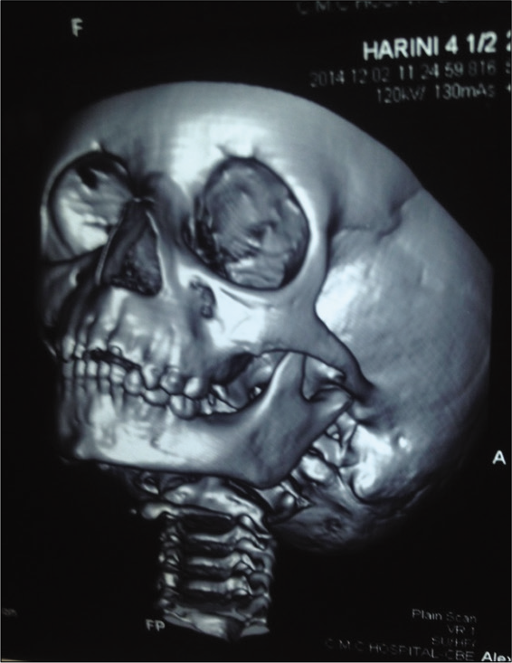 CT scan – left side.