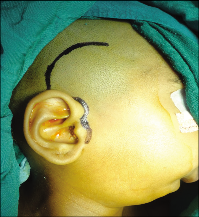 Pre-auricular approach.