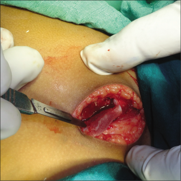 Dermis-fat graft.