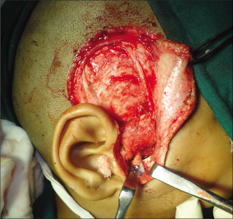 Coronoidectomy.