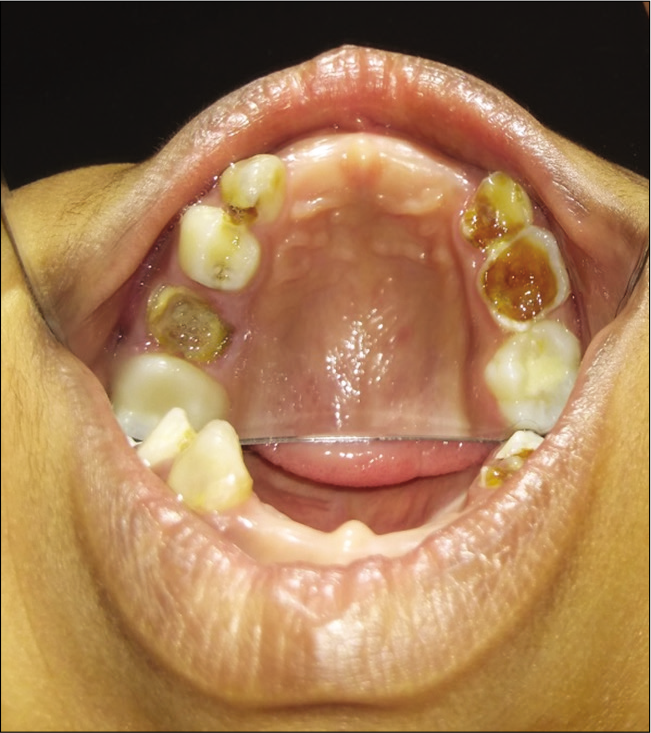 Maxillary arch.