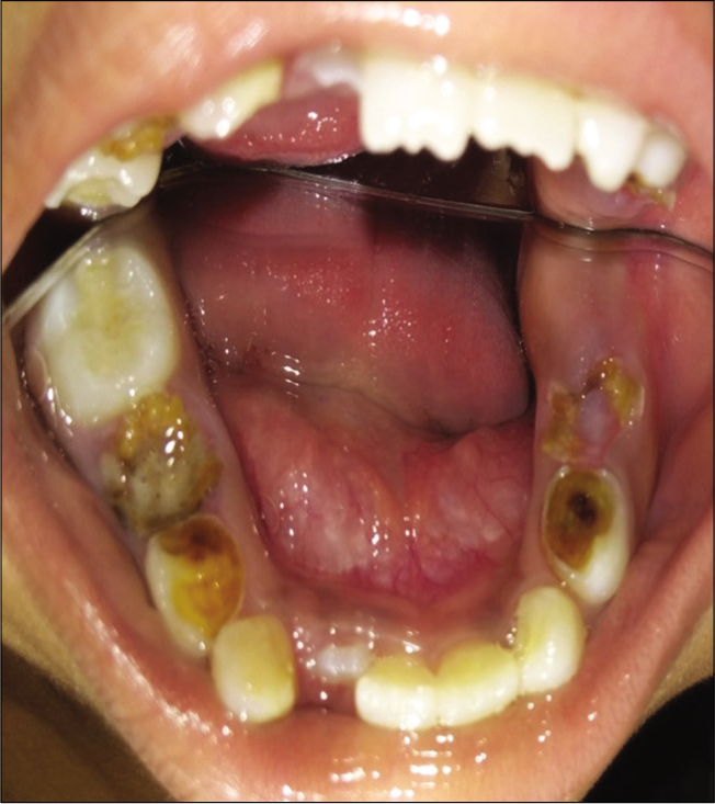 Mandibular arch.