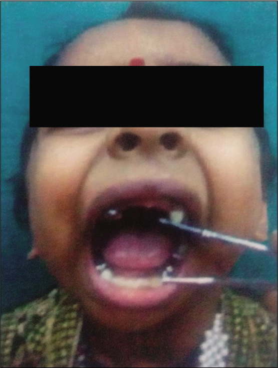 Mouth opening after physiotherapy.