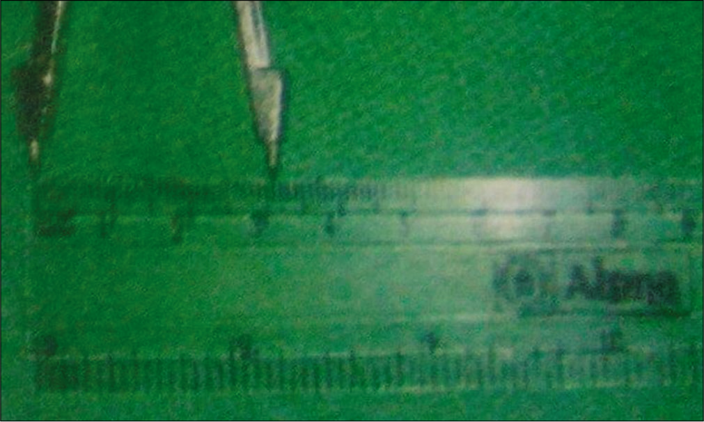 Measurement of 3 cm mouth opening.