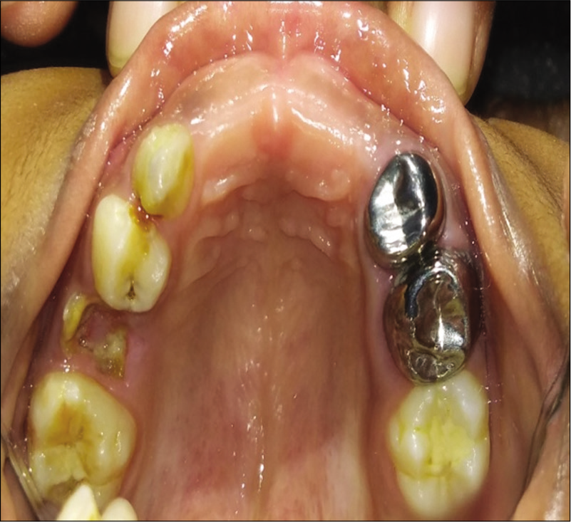 Post-operative maxillary arch.