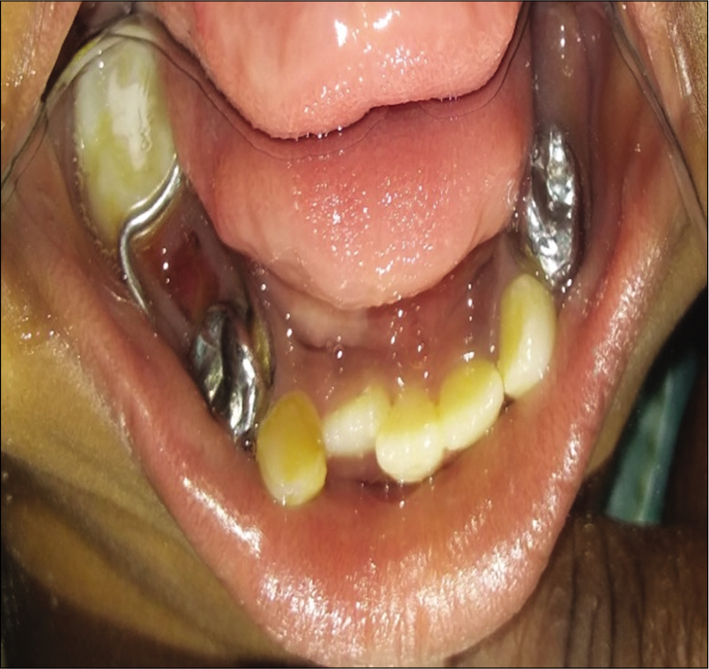 Post-operative mandibular arch.