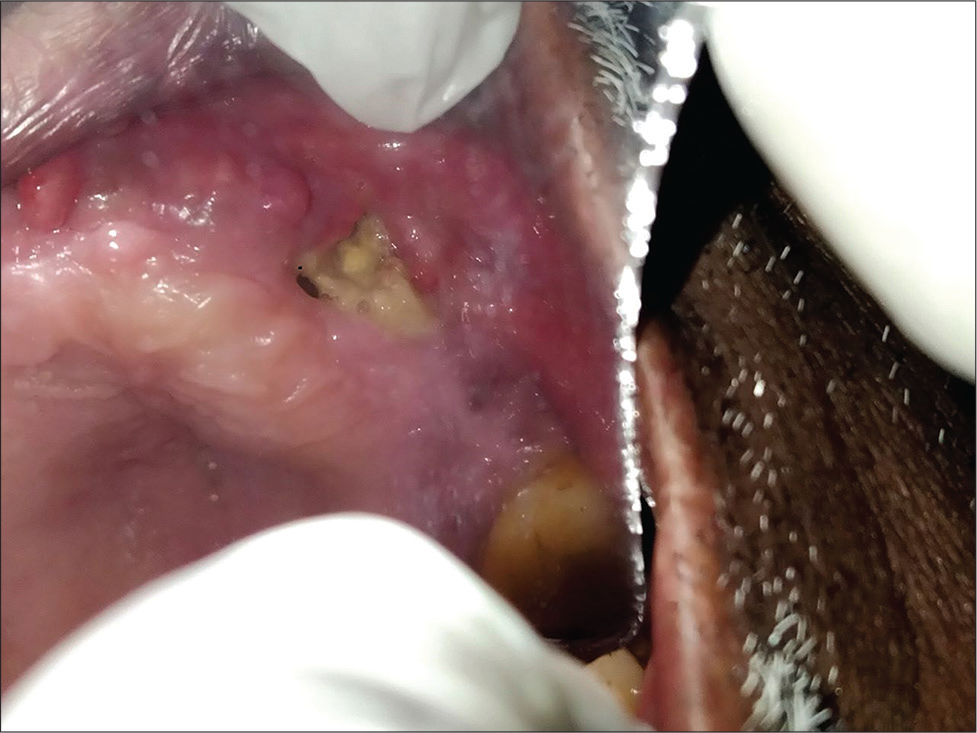 Mucormycosis invasion in hard palate.