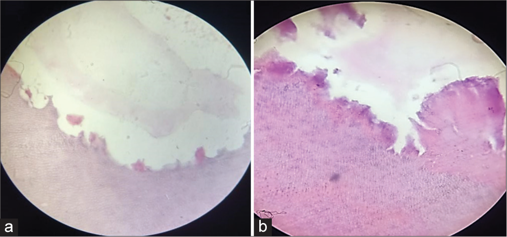 (a) Group A specimen under ×400 magnification showing scanty inflammatory cells and odontoclastic activity. (b) – Group B specimen under ×400 magnification showing diffuse and patchy pattern of inflammatory cells and hyperemia.