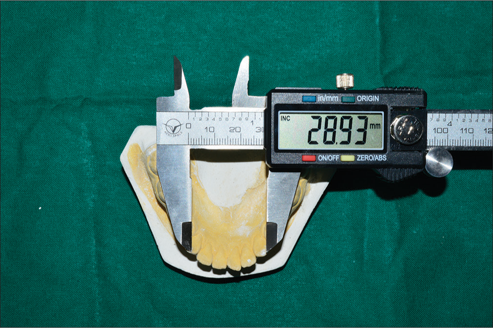 Measurement of intercanine arch width in mandibular study model using digital vernier caliper.