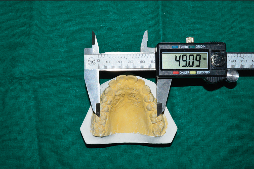 Measurement of intermolar arch width in maxillary study model using digital vernier caliper.