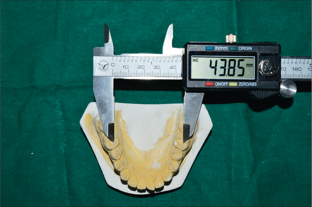 Measurement of intermolar arch width in mandibular study model using digital vernier caliper.