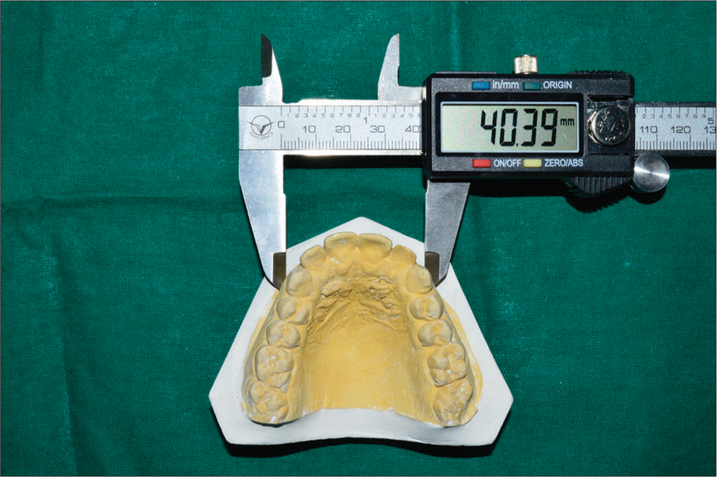 Measurement of canine fossa width in maxillary study model using digital vernier caliper.