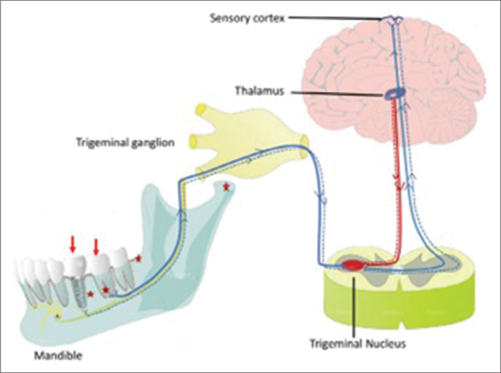 Sensory pathway for tooth/implant stimuli (red stars)-sensory nerve endings, (blue and red solid lines) neurosensory pathway feedback.