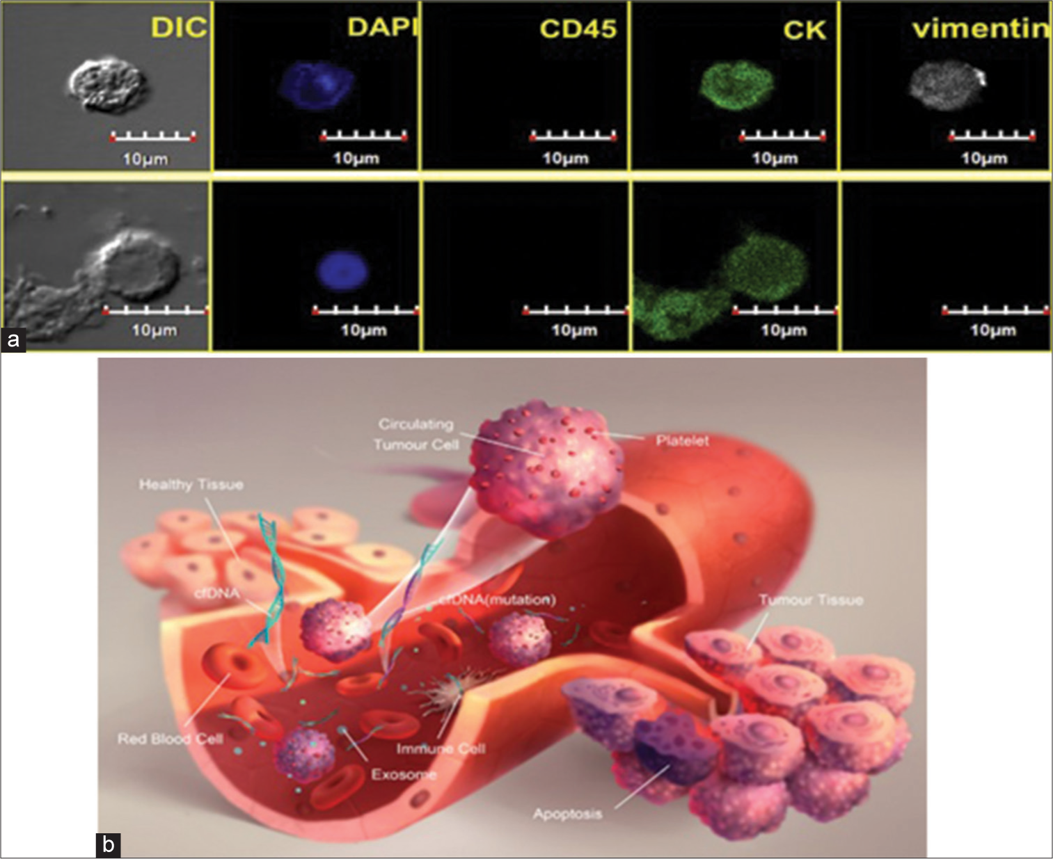 (a) Circulating tumor cell multi-marker staining in SCCHN. An immunocytochemical marker examination of a CTC. The cells are DAPlb (40,6-diamidino-2-phenylindol) and CD 45, respectively. Both have cytokeratin (CK) positivity, but only the first has vimentin positivity, which indicates mesenchymal tissue.[2] (b) Exosomes.[1]