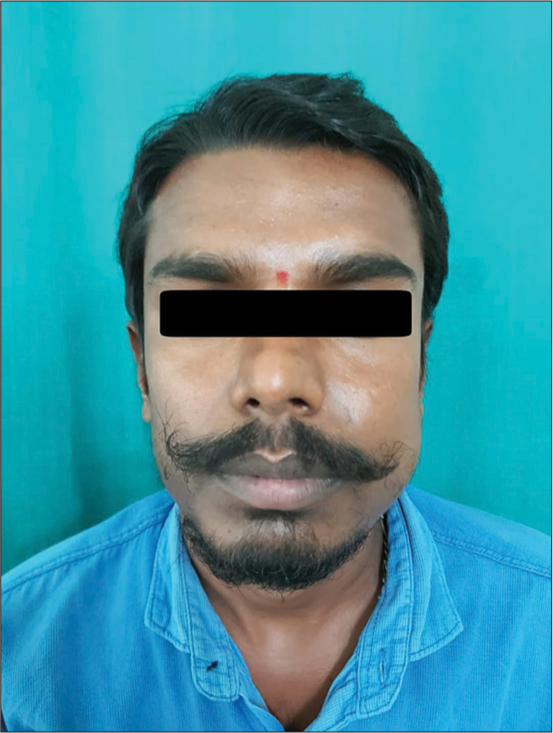 Central giant-cell granuloma of the left mandible depicting a marked extraoral swelling and associated facial asymmetry.