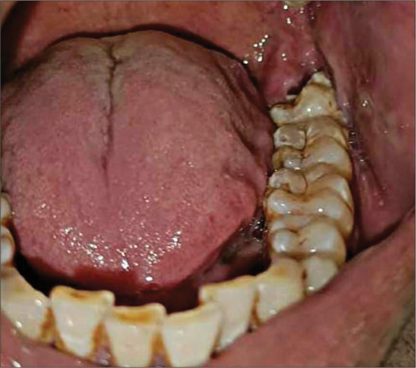 Obliteration of left lower buccal vestibule and pericoronitis of 38.