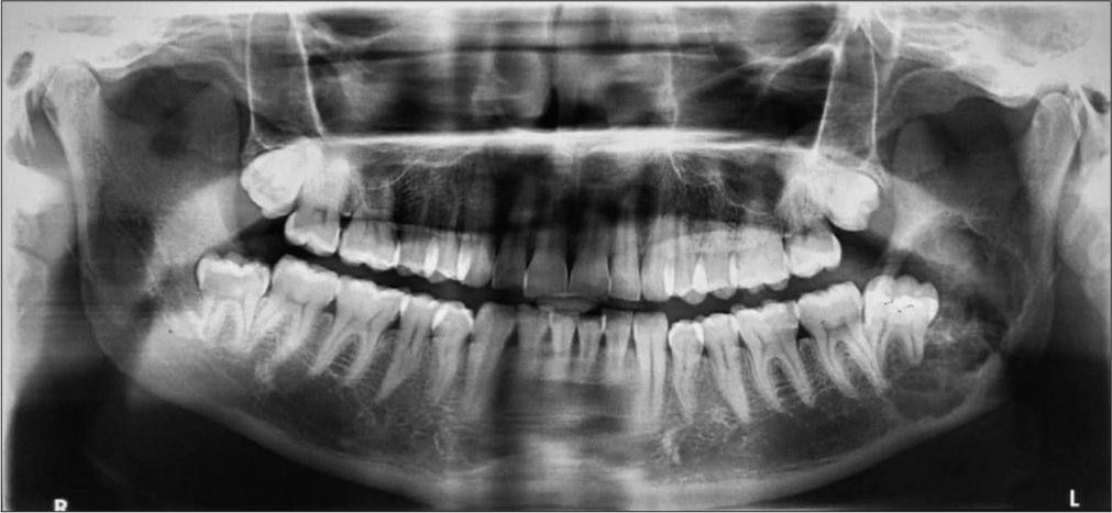 Orthopanthamogram depicting radiolucent lesion with associated impacted lower left third molar extending upto mid ramal region.