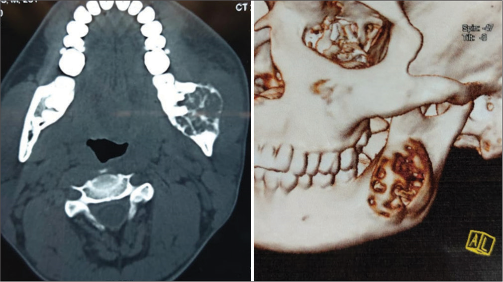 Computed tomographic image depicting well defined multilocular expansile lytic lesion measuring 4.4 × 3.2 × 2.9 cm in left ramus of mandible with a 3D reconstruction.