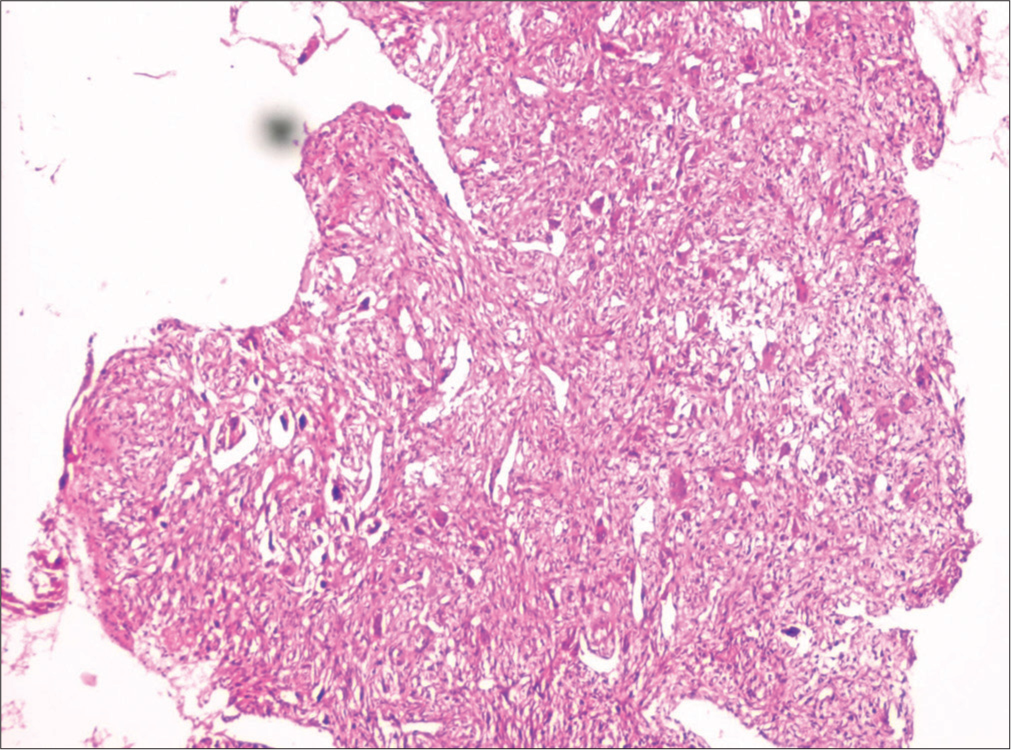 Histopathological evaluation depicting whorls of collagen fibers and multinucleated giant cells suggestive of central giant cell granuloma.