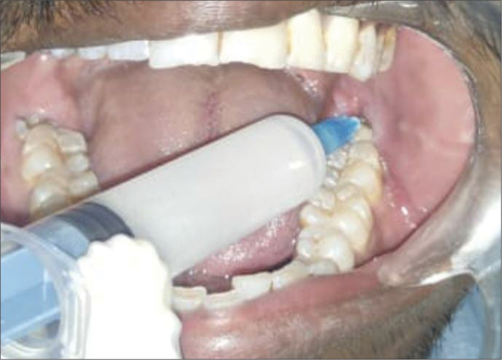 Intralesional corticosteroid injection – 5 mL per injection of triamcinolone (10 mg/mL) with 2% lignocaine.