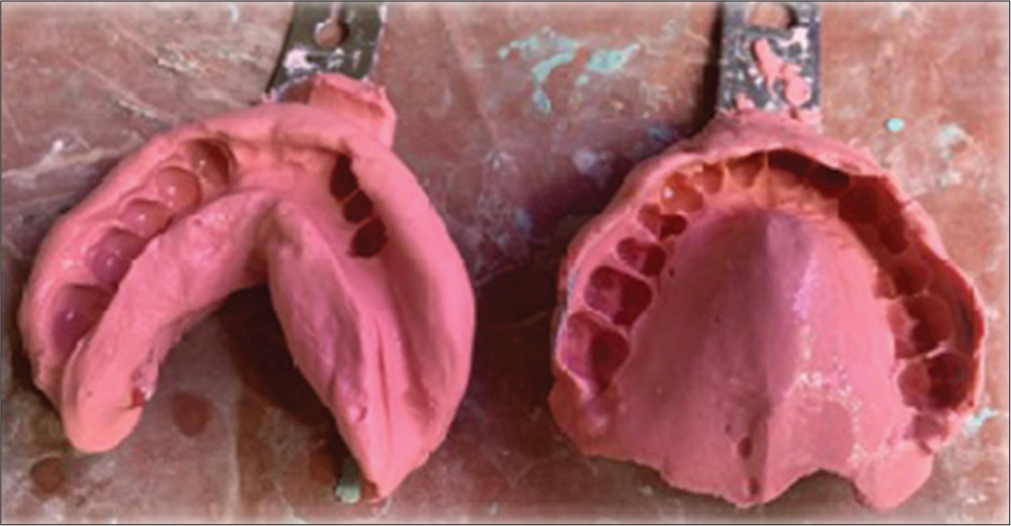 Maxillary and mandibular impressions.