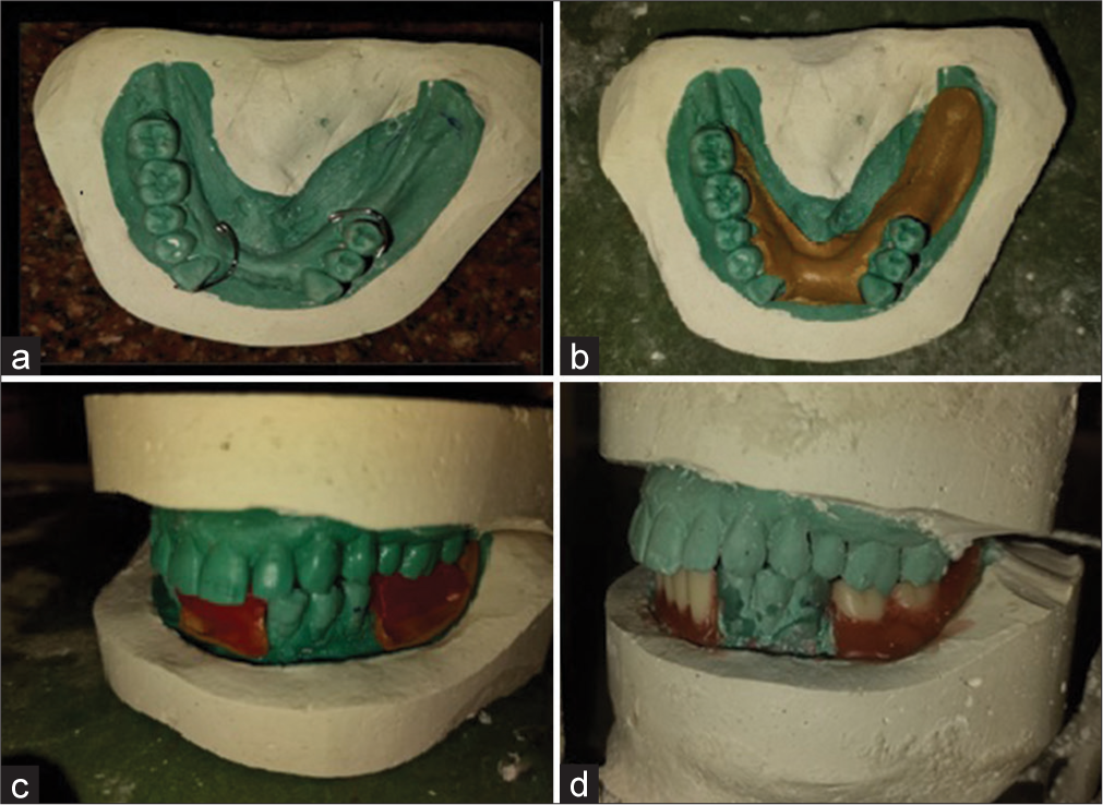 (a) Wrought wire adaptation on cast, (b) temporary record base adaptation, (c) bite rim fabrication, and (d) teeth set-up on articulator.