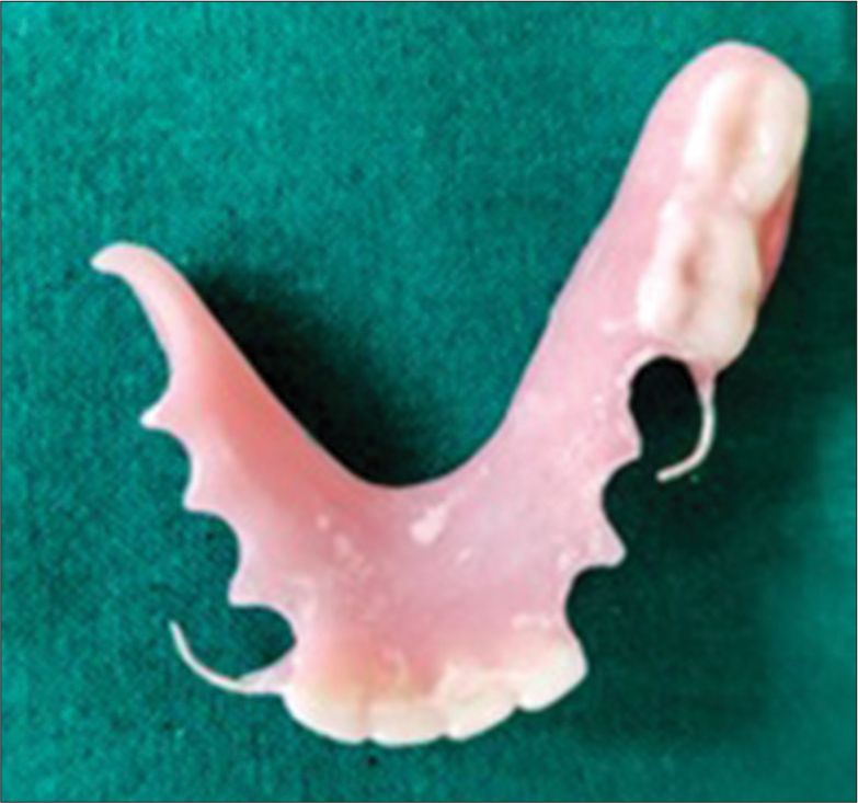 Processed acrylic removable partial denture.