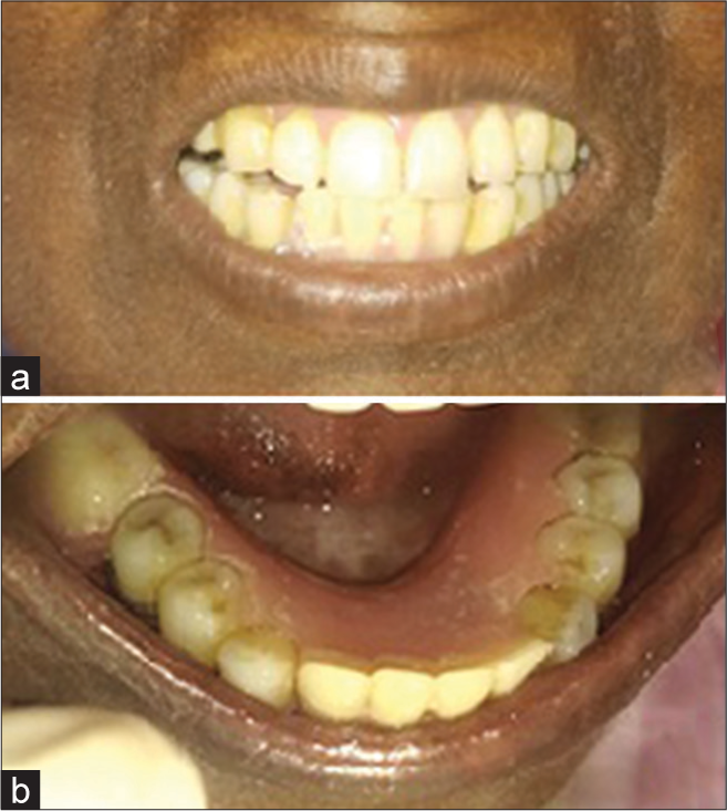 (a) Facial view after removable partial denture (RPD) insertion and (b) intraoral view after RPD insertion.