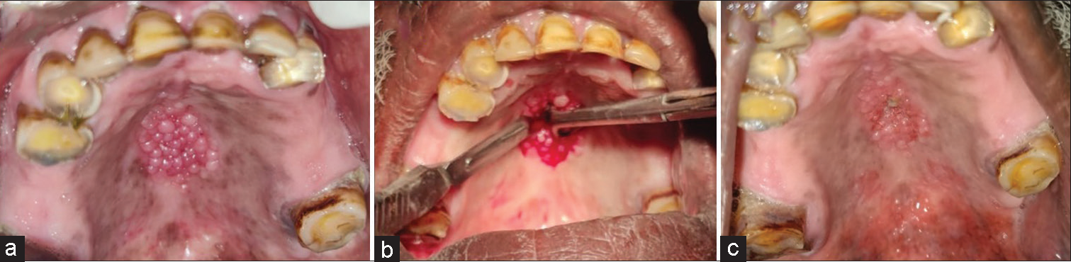 (a) Papillary growth along the mid-palatal raphe, (b) incisional biopsy, (c) and postoperative photograph after 1 week.