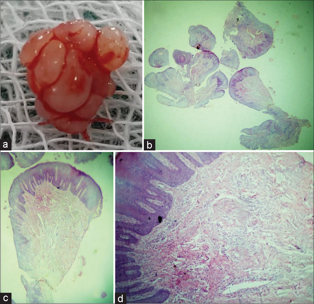 (a) Biopsy specimen showing the papillary pattern of growth appreciated clinically, (b and c) photomicrograph of papillary growth, H and E, ×0.7, ×1, and (d) photomicrograph showing parakeratinized stratified squamous surface epithelium and underlying highly cellular stroma with chronic inflammatory cells. H and E, ×20.