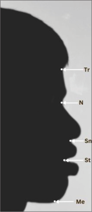 Silhouette profile photo of Class I bimaxillary protrusion patient with landmarks.