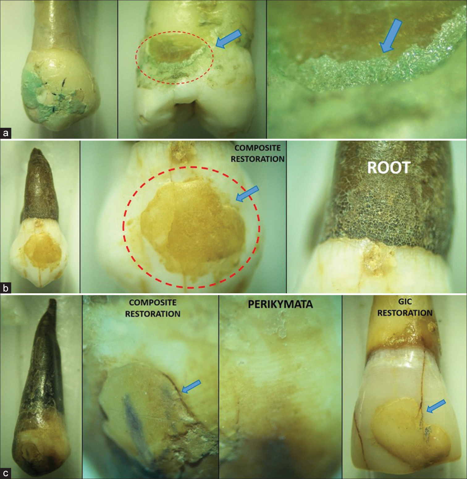 Staining observed under stereozoom microscope: (a) Commercial mouthwash (M2), Red dashed circle - Cemento-Enamel Junction, blue arrow - higher magnification of Cemento-Enamel Junction. (b) Chewable Tobacco (M4), Red dashed circle - Composite filling taking up stain, blue arrow - junction between tooth and restoration and (c) Coffee (M7),blue arrow - area of staining between restoration and tooth.